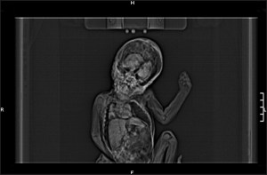 IndianJDentRes_2012_23_5_686_107411_u1